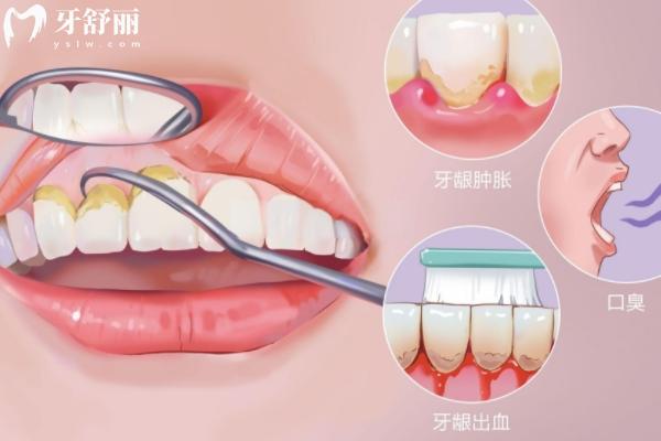 在家超聲波洗牙靠譜嗎？