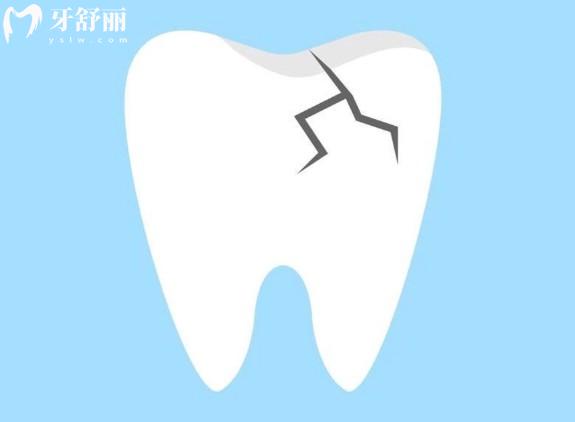 什么是牙隱裂