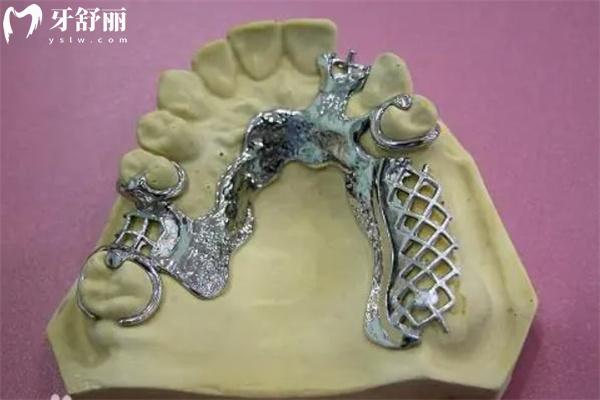 上海安裝假牙義齒多少錢?分享上海全口假牙價(jià)格表及裝假牙口腔醫(yī)院排名