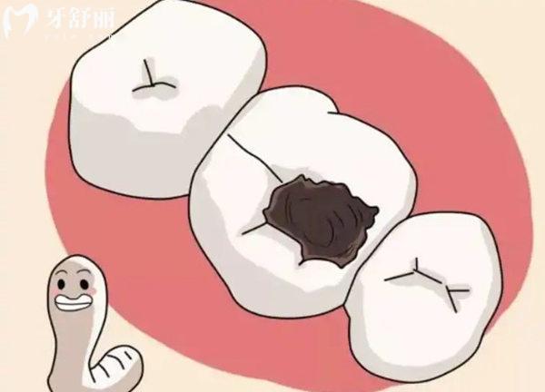 我們看看哪幾類牙洞是一定要補呢