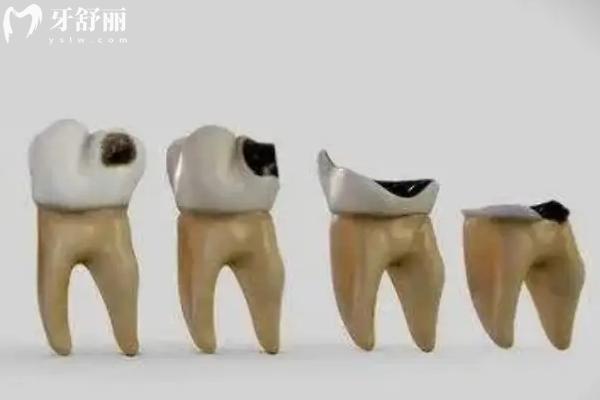只剩牙根的牙不拔掉沒(méi)事吧