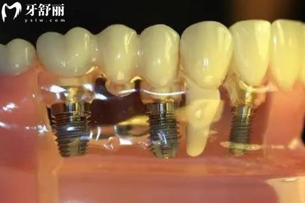 鈦鋯合金和純鈦哪個種植牙好？