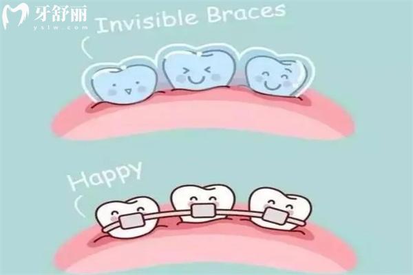 13歲女孩矯正半口牙多少錢?盤點(diǎn)牙齒矯正不同類型和難度的收費(fèi)區(qū)別