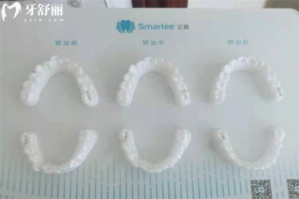 13歲女孩矯正半口牙多少錢?盤點(diǎn)牙齒矯正不同類型和難度的收費(fèi)區(qū)別