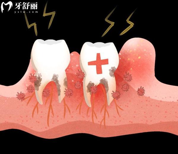 怎么判斷牙周炎的嚴(yán) 重程度