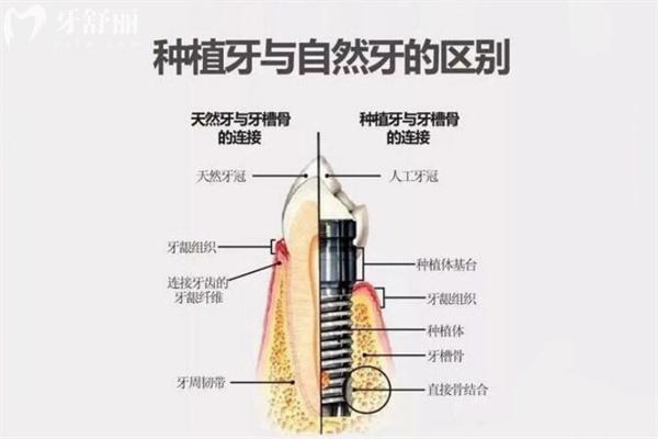 常見牙科項(xiàng)目治療后維持時(shí)間多長揭秘