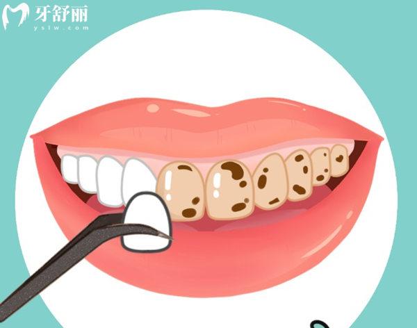 全瓷貼面厚點好還是薄點好