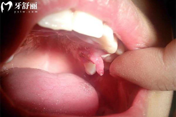 爛牙根里長(zhǎng)息肉怎么治療