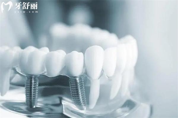 五六十歲缺牙老人如何選擇假牙？來(lái)看不同假牙類(lèi)型的使用壽命及優(yōu)勢(shì)盤(pán)點(diǎn)