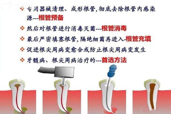 磨牙根管治療要幾次才能好