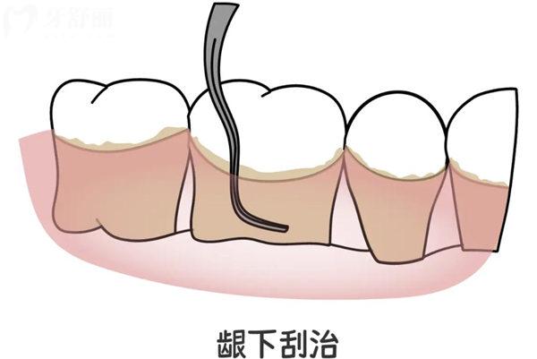齦下刮治要做幾次?輕度/重度/重度不同程度的牙周情況治療次數(shù)不同