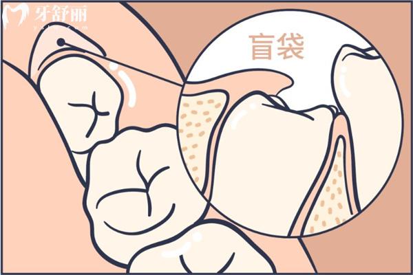 為什么阻生智齒一定要拔掉?先來(lái)詳細(xì)了解阻生智齒的危害吧!