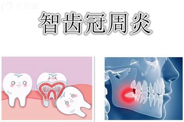 為什么阻生智齒一定要拔掉?先來(lái)詳細(xì)了解阻生智齒的危害吧!