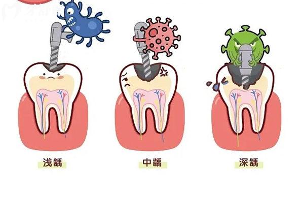 為什么會(huì)牙髓壞死？