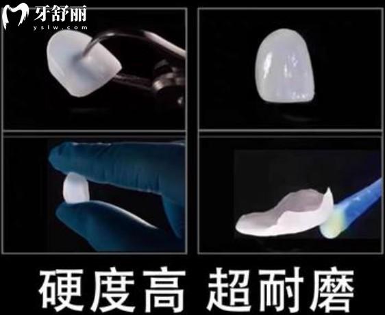 義獲嘉藍(lán)瓷牙貼面使用注意事項