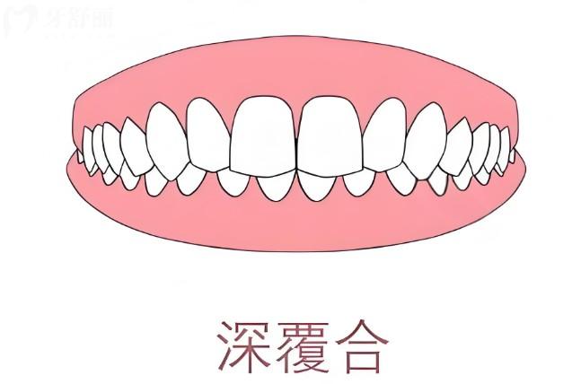 深覆合幾度怎么看的?這里手把手教你怎么判斷自己是否深覆合
