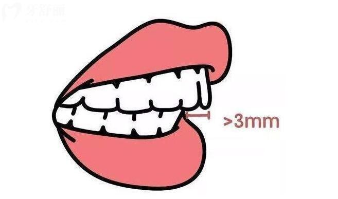 深覆合幾度怎么看的?這里手把手教你怎么判斷自己是否深覆合