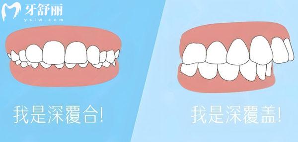 深覆合幾度怎么看的?這里手把手教你怎么判斷自己是否深覆合