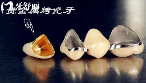 重慶烤瓷牙多少錢一顆