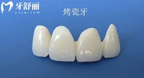 重慶烤瓷牙多少錢一顆價(jià)格表2025年
