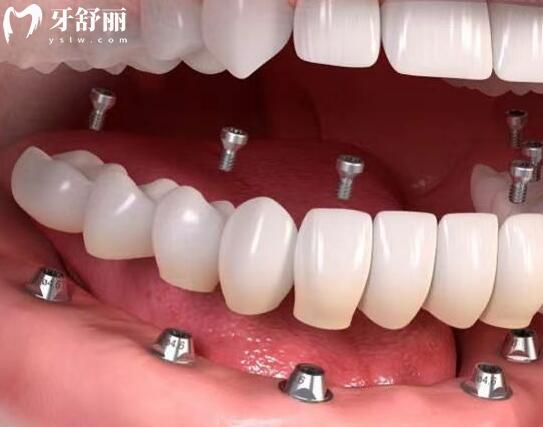美奧口腔種植牙收費(fèi)標(biāo)準(zhǔn)(2025價(jià)格清單):單顆種植牙2680元起、半口2萬(wàn)元起、全口4萬(wàn)元起