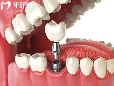 德國(guó)賽弗xive種植牙的材質(zhì)是什么?4級(jí)純鈦材質(zhì)