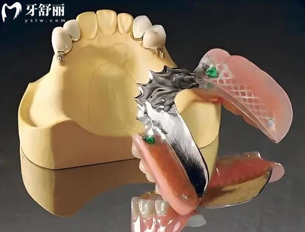 精密附著體的優(yōu)缺點(diǎn)