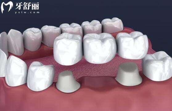 吸附性義齒與普通假牙的區(qū)別在固定方式
