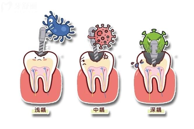 牙齒齲壞六種洞型怎么進行治療