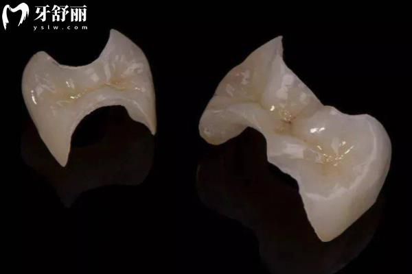 25年寧波補(bǔ)牙多少錢一顆牙價格表