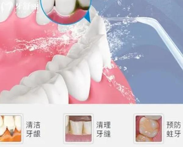 超聲波洗牙和噴砂洗牙區(qū)別