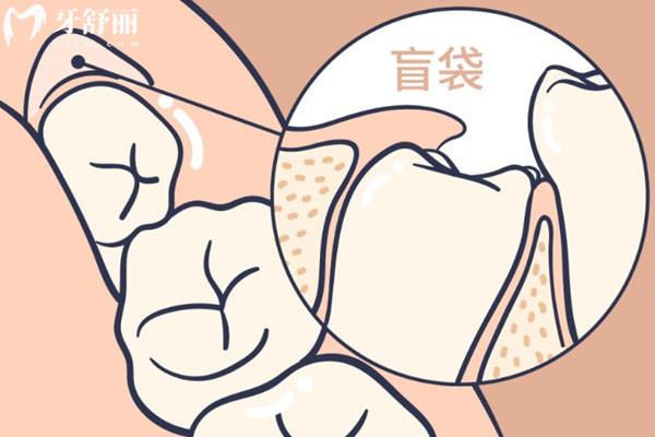 拔智齒需要哪些注意事項(xiàng)