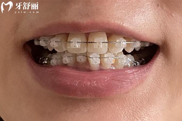 戴牙套多久換一次鋼絲合適