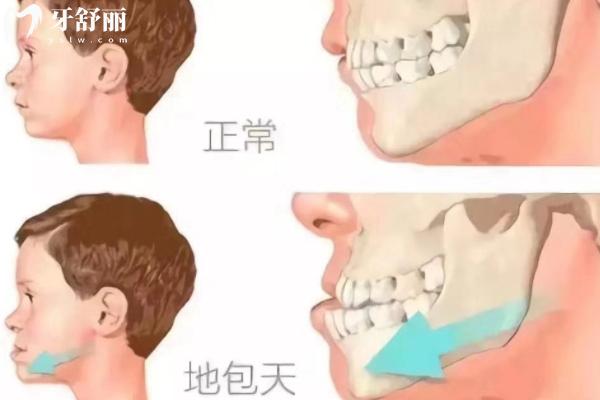 牙齒矯正必須等換完牙？