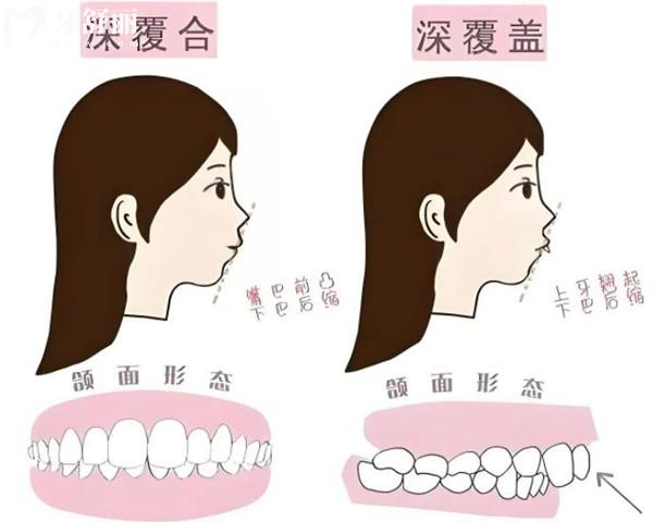 深覆合有哪些危害
