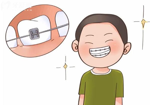 兒童下頜后縮幾歲矯正比較好