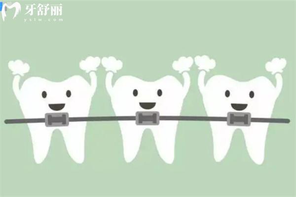 牙齒矯正全攻略：從年齡選擇到矯正器類型
