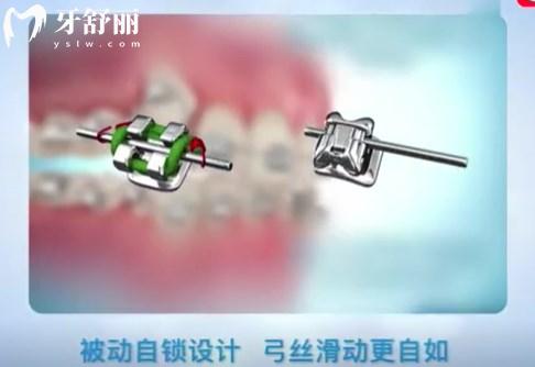 北京牙齒矯正多少錢?價(jià)格表顯示金屬托槽8k+隱形2w+舌側(cè)4.5w+附正畸醫(yī)院排名前五