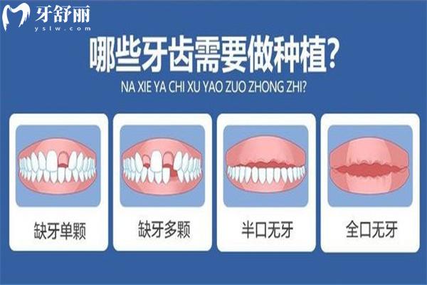 國(guó)內(nèi)種植牙收費(fèi)價(jià)目表
