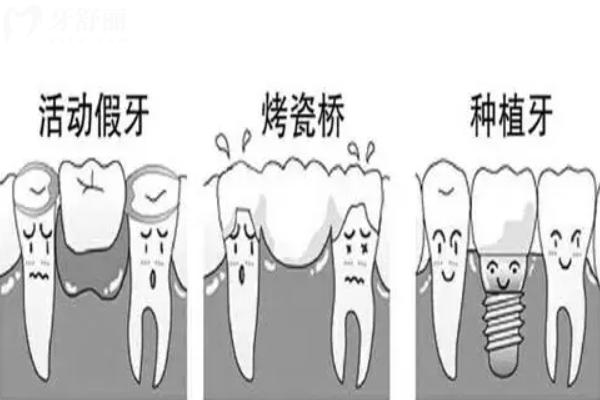 活動(dòng)假牙種類和價(jià)格