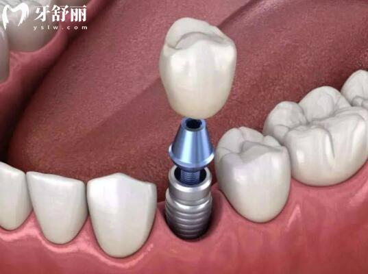 延吉種植牙多少錢2025年價格表:一顆2680-9500不等