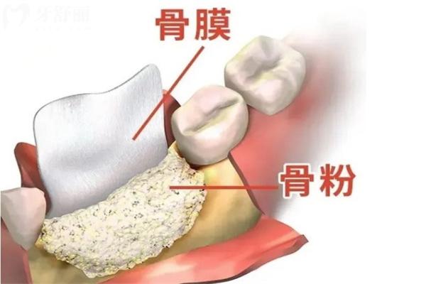 揭露種牙骨粉十大品牌榜:對(duì)比國產(chǎn)/進(jìn)口骨粉作用和功效還有價(jià)格分享