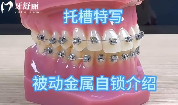 被動(dòng)自鎖托槽和主動(dòng)自鎖托槽的區(qū)別