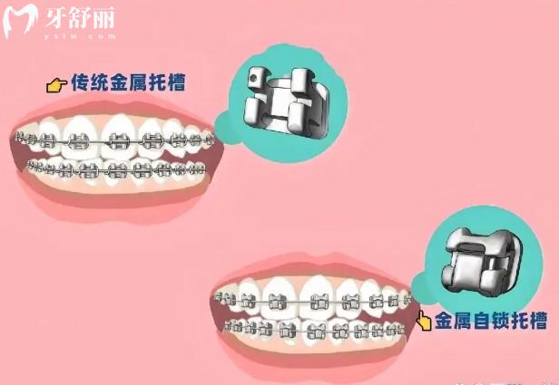 被動(dòng)自鎖托槽和主動(dòng)自鎖托槽的區(qū)別