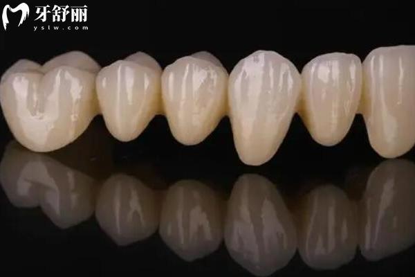 全瓷牙的壽命是幾年？10-20年左右