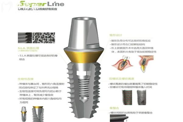 種牙什么牌子的性價比高?2025年國內(nèi)十大流行種植牙品牌排行榜來了解下