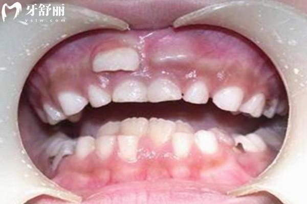 兒童多生牙從何而來