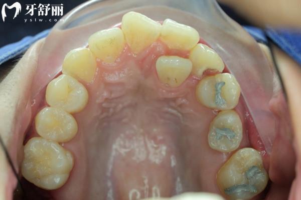 兒童多生牙從何而來