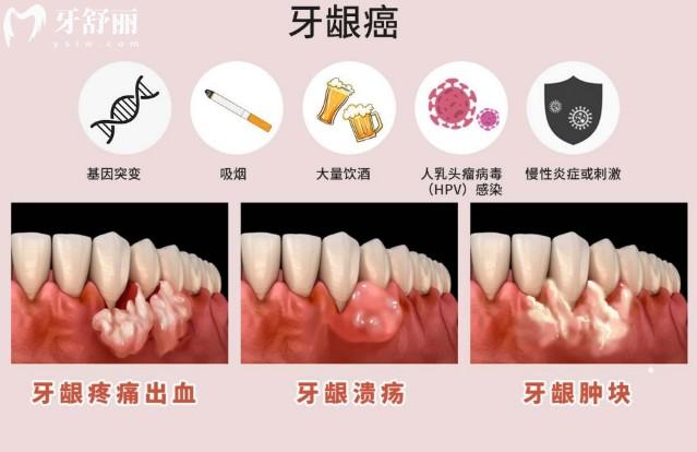 牙齦炎和牙齦癌的區(qū)別是啥？