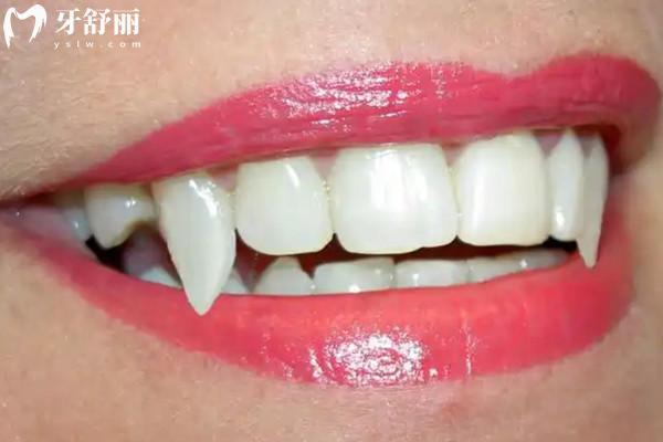 牙齒矯正可以保留虎牙嗎